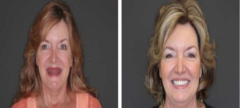 This 59 year-old female patient is otherwise healthy but she was looking to create a mouth and smile to match her vivacious approach to life. She wore a conventional upper denture for over ten years and grew tired of the high maintenance that offere
