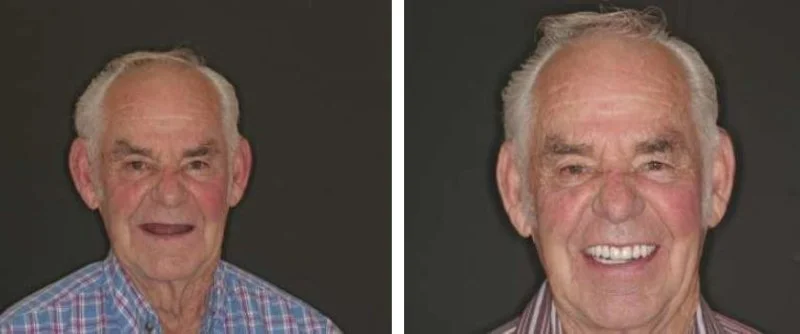  Tired of wearing a loose, uncomfortable partial denture??&nbsp; If so, we have just the solution for you!&nbsp; With dental implants, your partial denture can be a thing of the past.&nbsp; By utilizing the latest in dental technology we can do most 