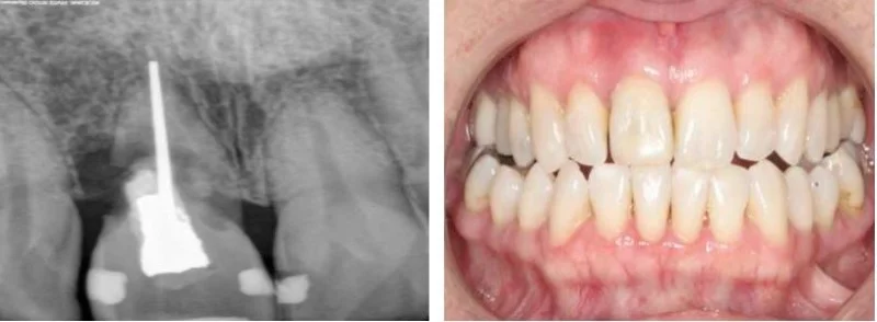   Resorbing Tooth Root :&nbsp;&nbsp; Act Immediately!   Most patients are procrastinating the day until the tooth breaks off before doing something to remedy this dental challenge.&nbsp; Unfortunately, most dental patients are unaware of this just ho