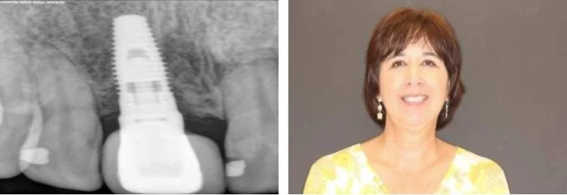  ... Continued.&nbsp;  Combination Defects (the sunken in area) present one of the biggest challenges of all when it comes to esthetic implant dentistry. These cases require not only that the implant is placed at the right angle and position, they al