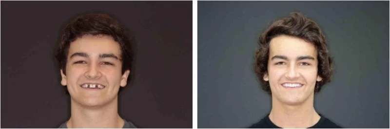 This fun loving 17 year old from Kaysville, Utah was born missing his maxillary lateral incisors.&nbsp;&nbsp;Following the completion of his orthodontic care, we placed dental implants and plumped out his gums so the new teeth would look natural and