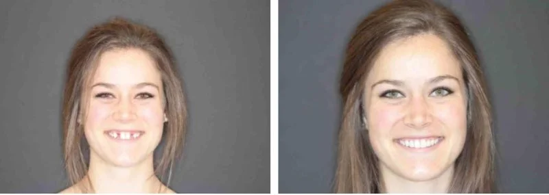  This beautiful 18 year-old was born missing her permanent lateral incisors.&nbsp; Once her Orthodontic care, she has worn a retainer to "fill in the space" of the missing teeth.&nbsp; She is ready for a permanent solution that look and feel like her