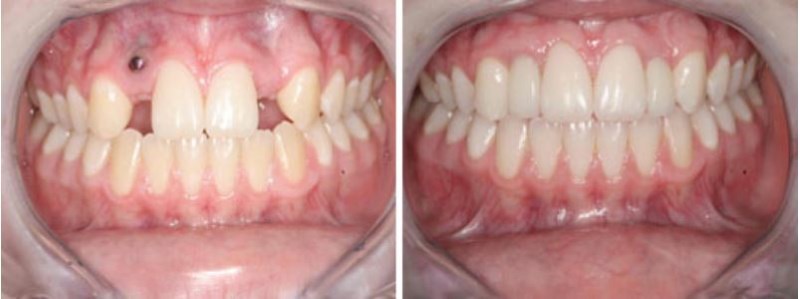  This 20 year-old female from Mapleton, Utah had two dental implants placed by someone who lacked the proper implant training and experience, as shown by the left implant protruding out of the gum tissue. We removed the ill-placed implant and repaire