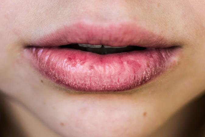 How to Avoid Chapped Lips this Winter — Boulder Skin Source