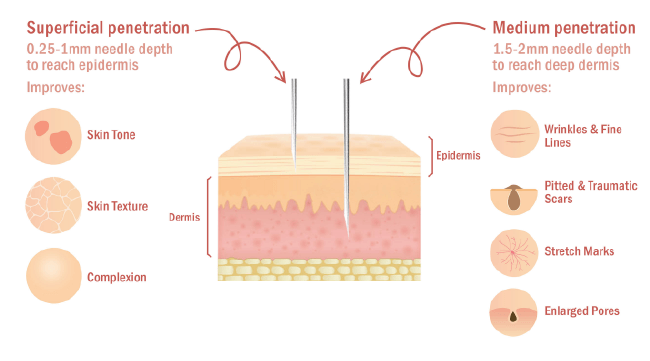 Microneedling Depth Guide | Microneedling Depth: Understanding Optimal ...