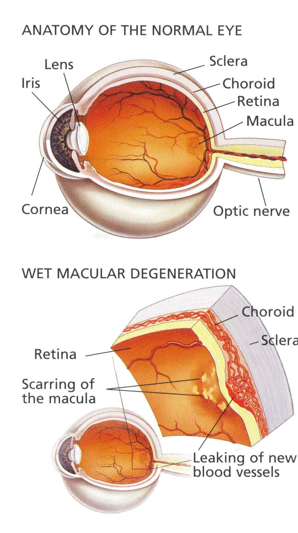 macular_degeneration_large.jpg
