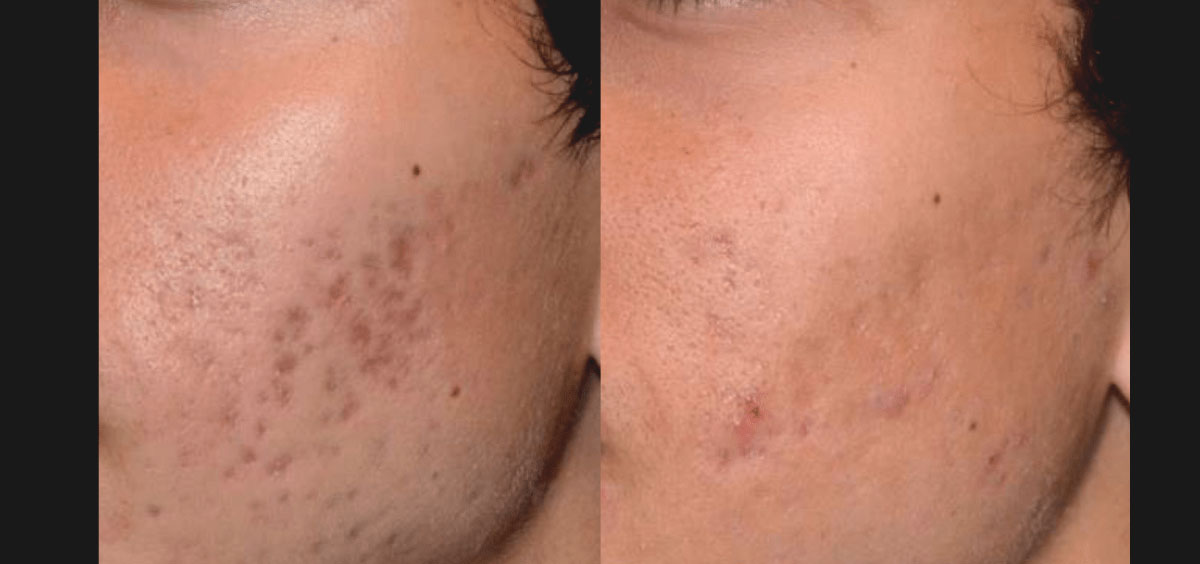 Laser Treatment Acne Scars Before After