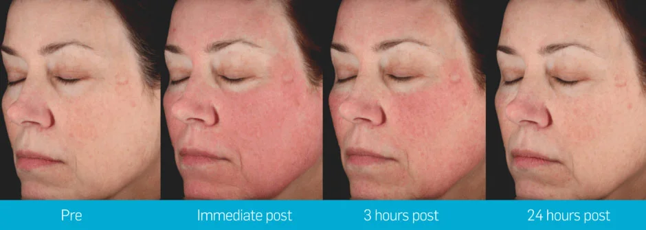 picosure_face_transition_002-940x335.jpg