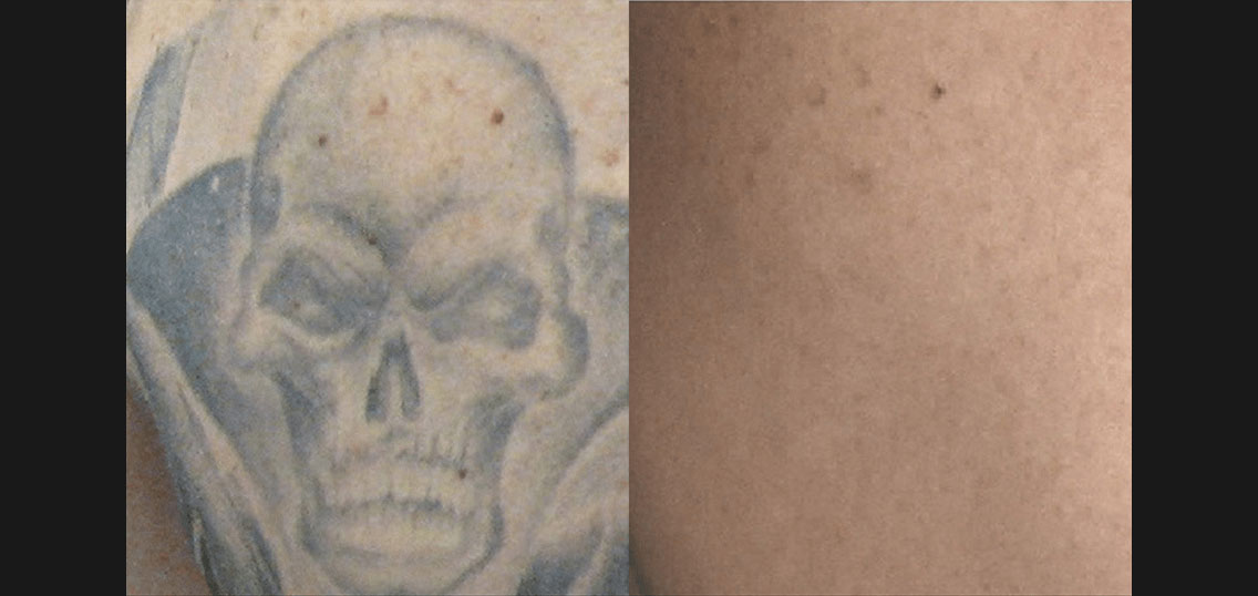 BA_PicoSure_Hall-Plastic-Surgery_Post4Tx_Tattoo.jpg