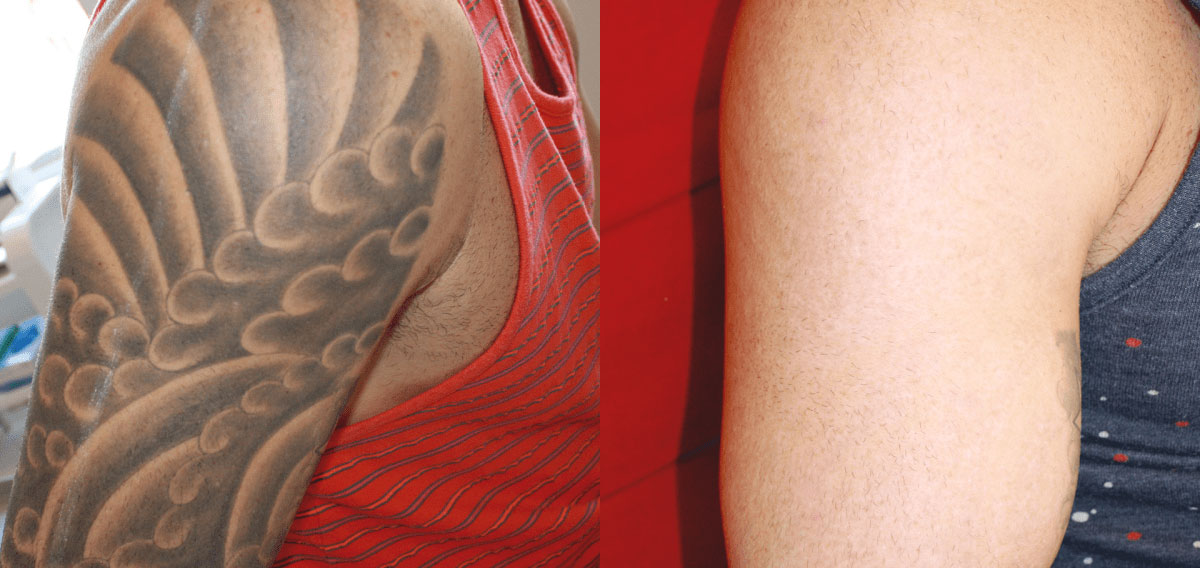 Tattoo Removal Before  After Photos  Laser Tattoo Removal in Denver
