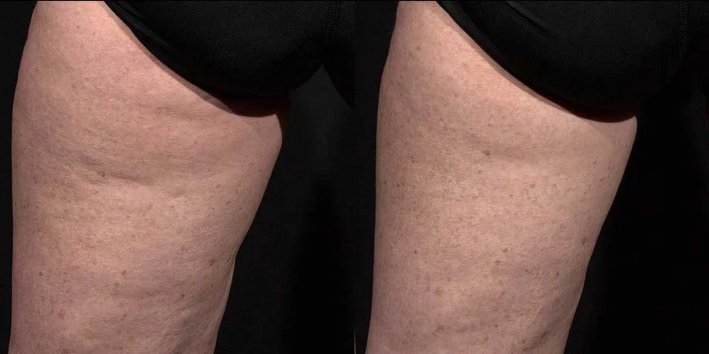 FADE_TempSure_Firm_Before+After2.jpg
