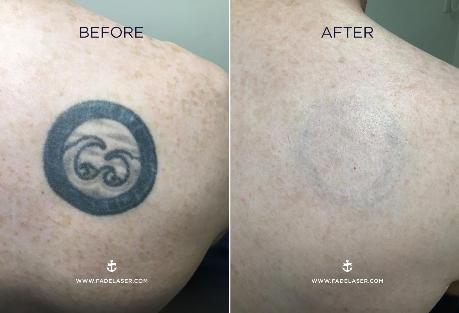 Tattoo Removal  Before and After Images