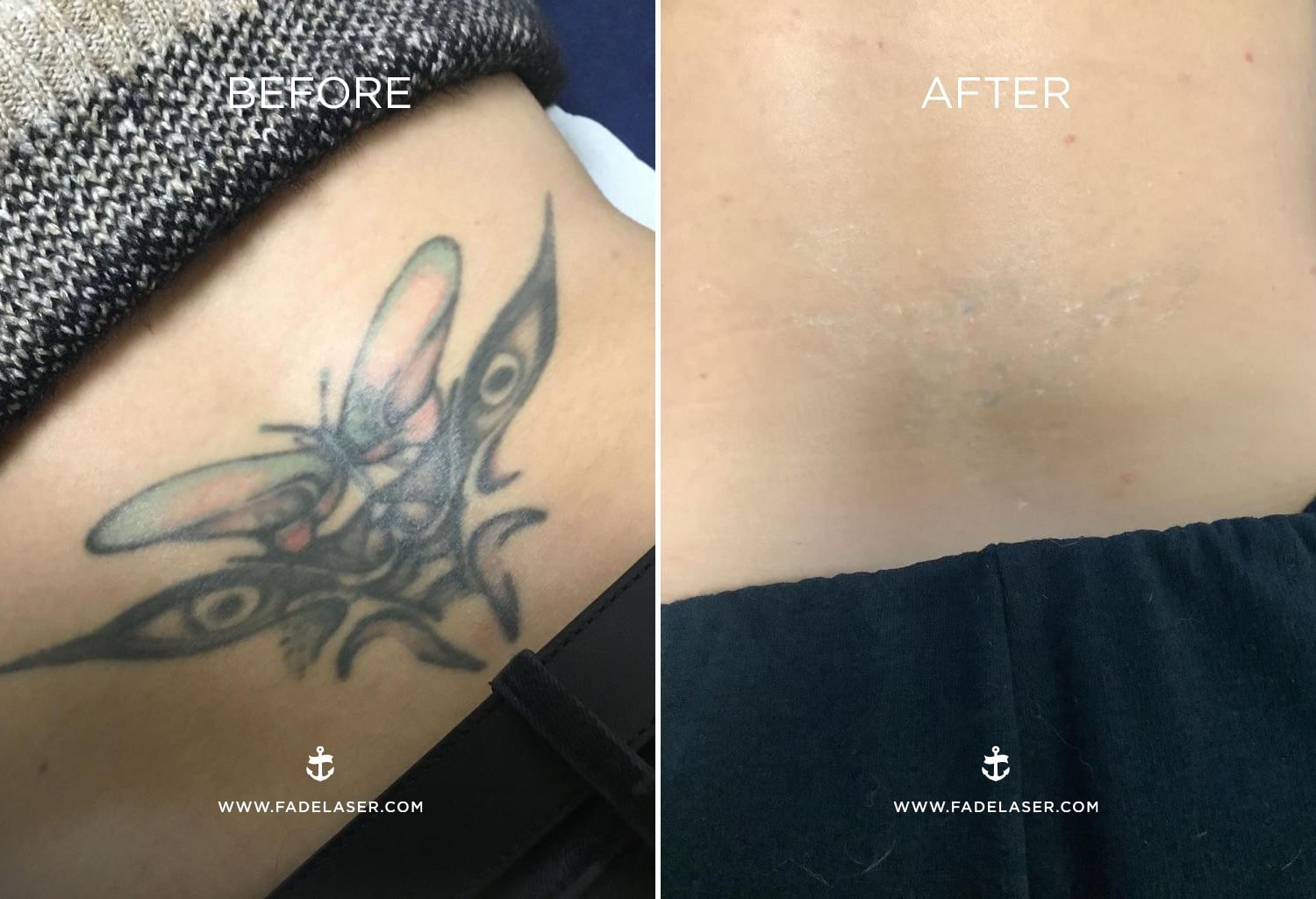 Laser Tattoo Removal -