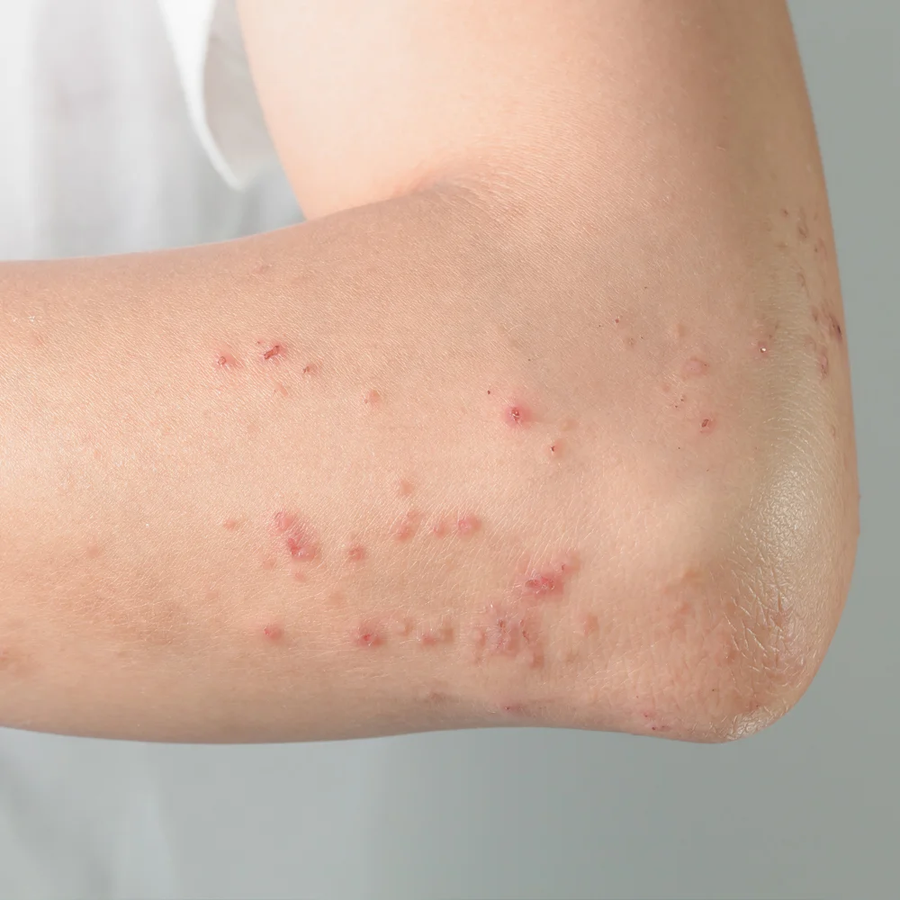 Bountiful Skin Rash Treatment & Examination: Skin Care Clinic