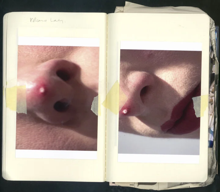 Notebook pages show photos of a large pustulated spot on the tip of a nose.