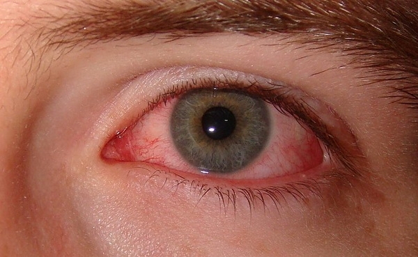 dry-eyes-2.jpg