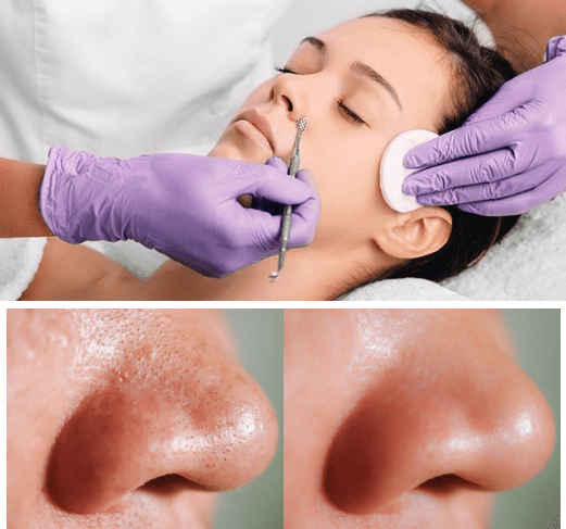 Deep pores cleansing Le salon Paris Sunny isles.png