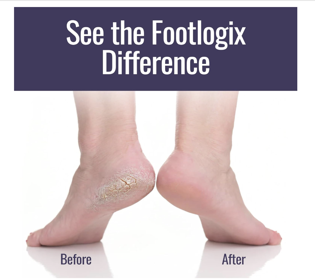 footlogix Treatment.png