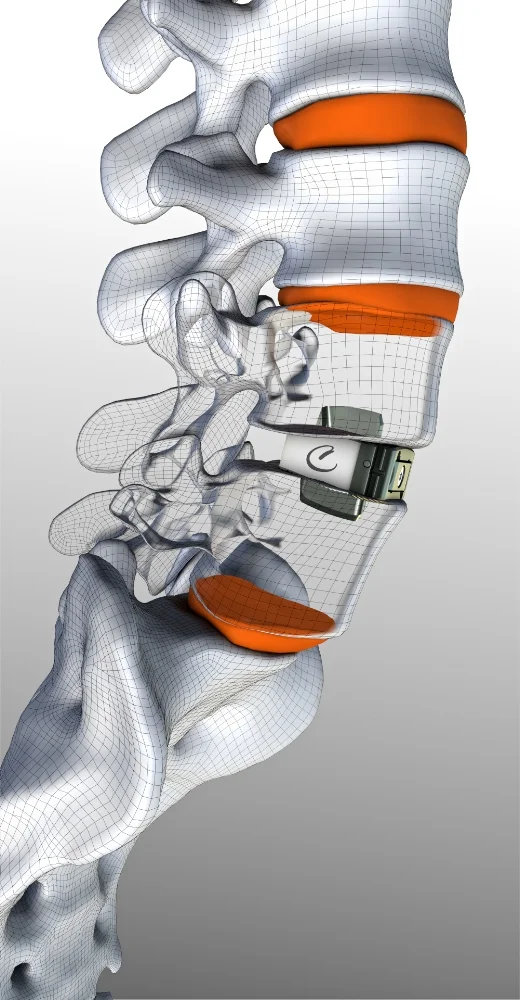 ENZA™ ALIF WITH DUO PRESA™ (TWO GRIPS) ANCHOR TECHNOLOGY