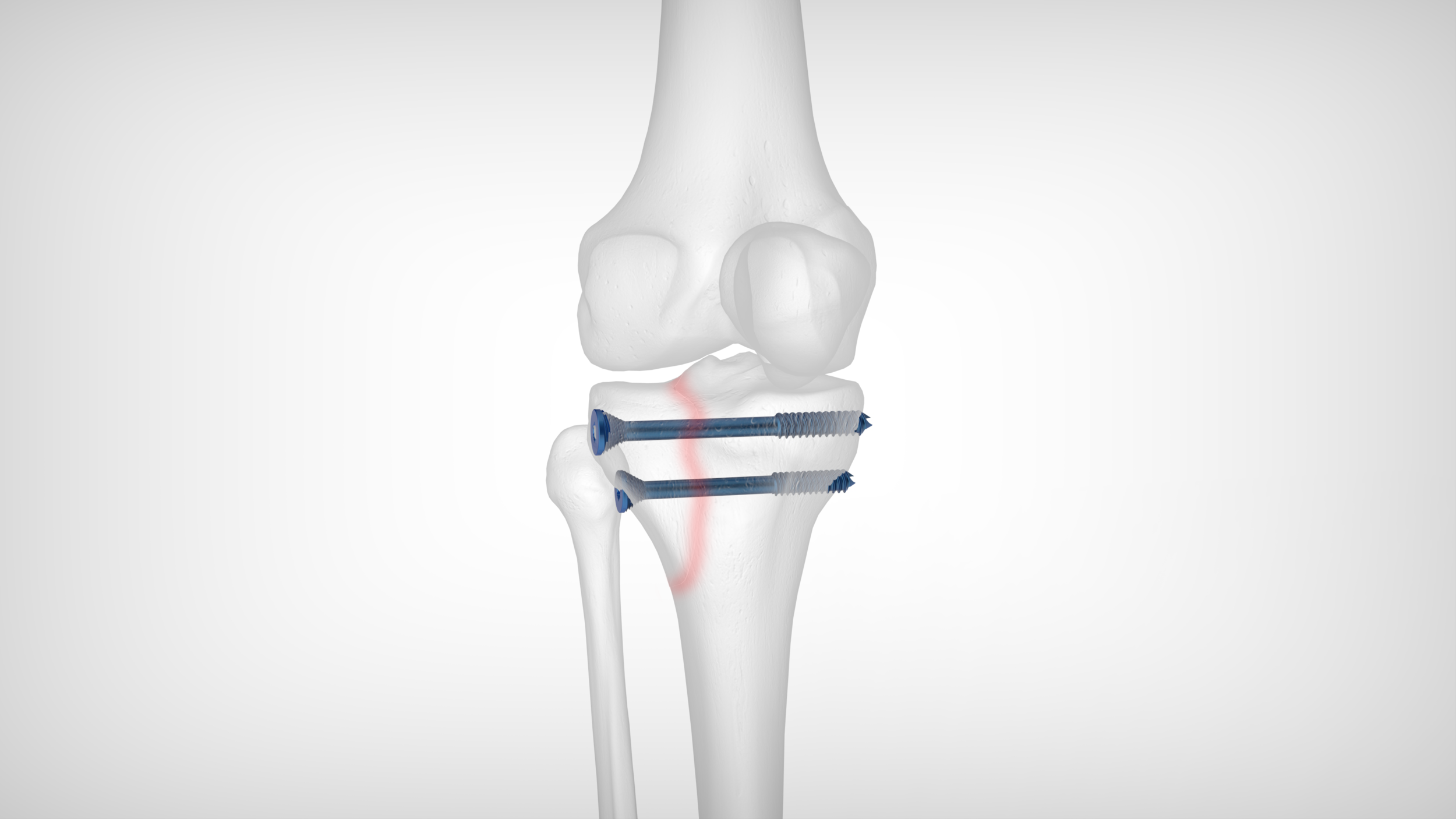 Siconus_tibial2.311.png