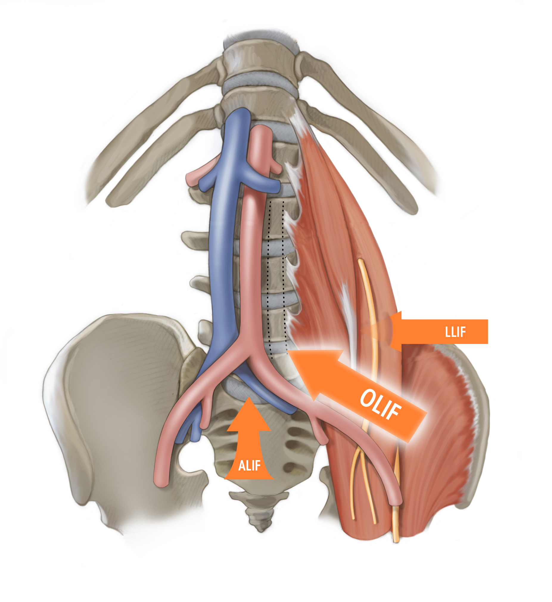 SpineApproaches.png