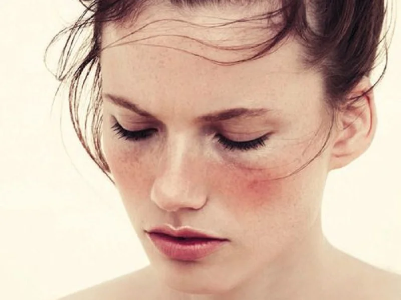 THE INTERNAL APPROACH TO ROSACEA