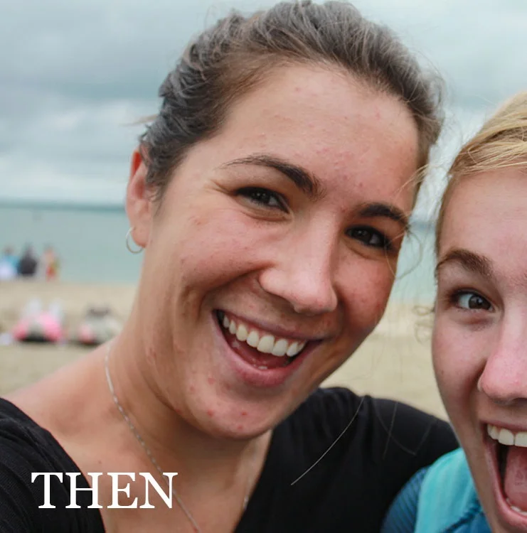 JENNY BARROW | HEALING ACNE THE HOLISTIC WAY