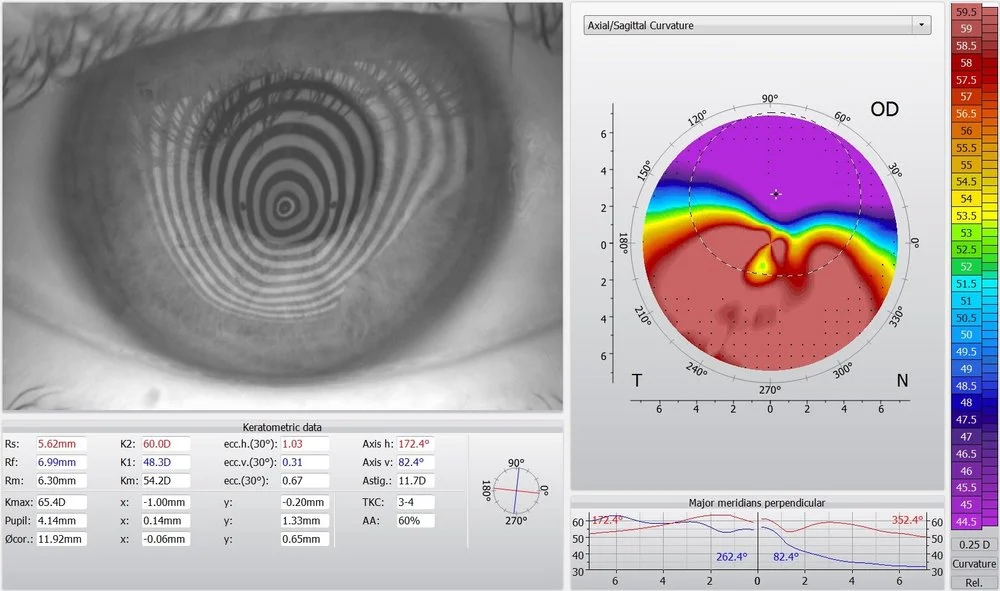 keratoconus+topography.jpg