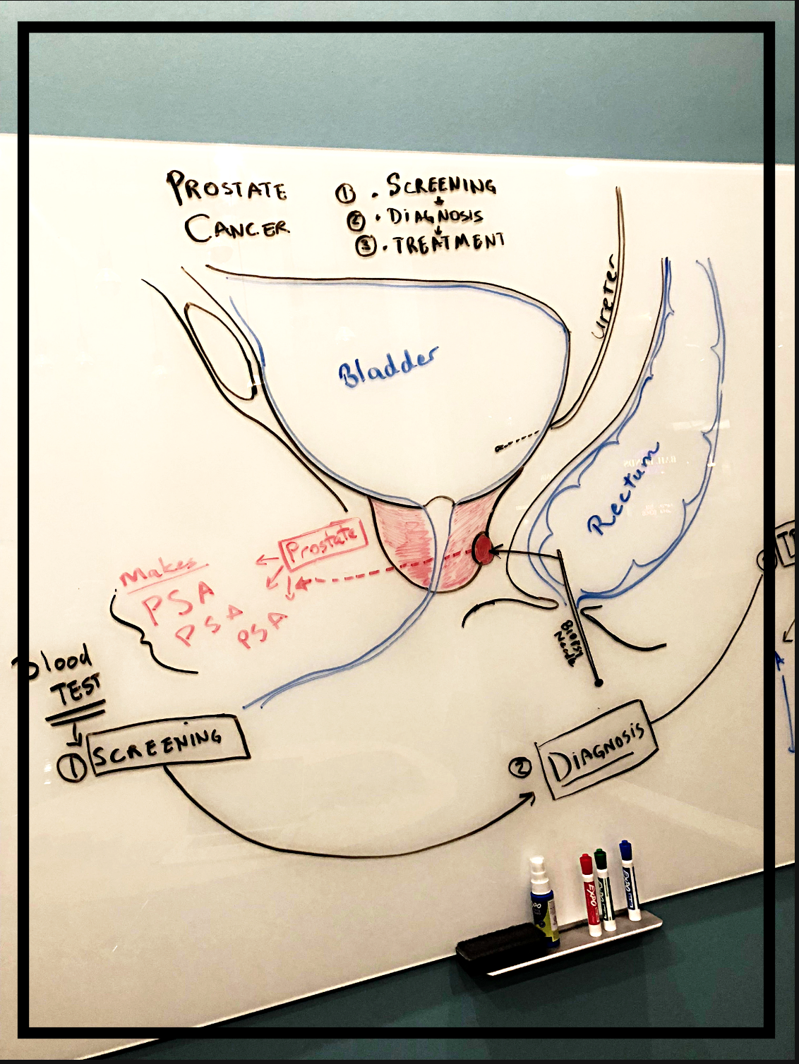 Prostate cancer - illustration of screening, diagnosis and treatment options. Copyright: Fairbanks Urology, LLC