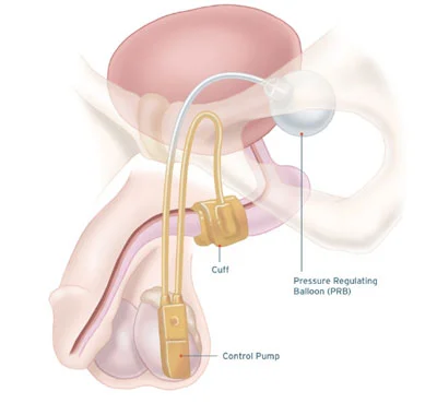 artificial-sphincter.jpg