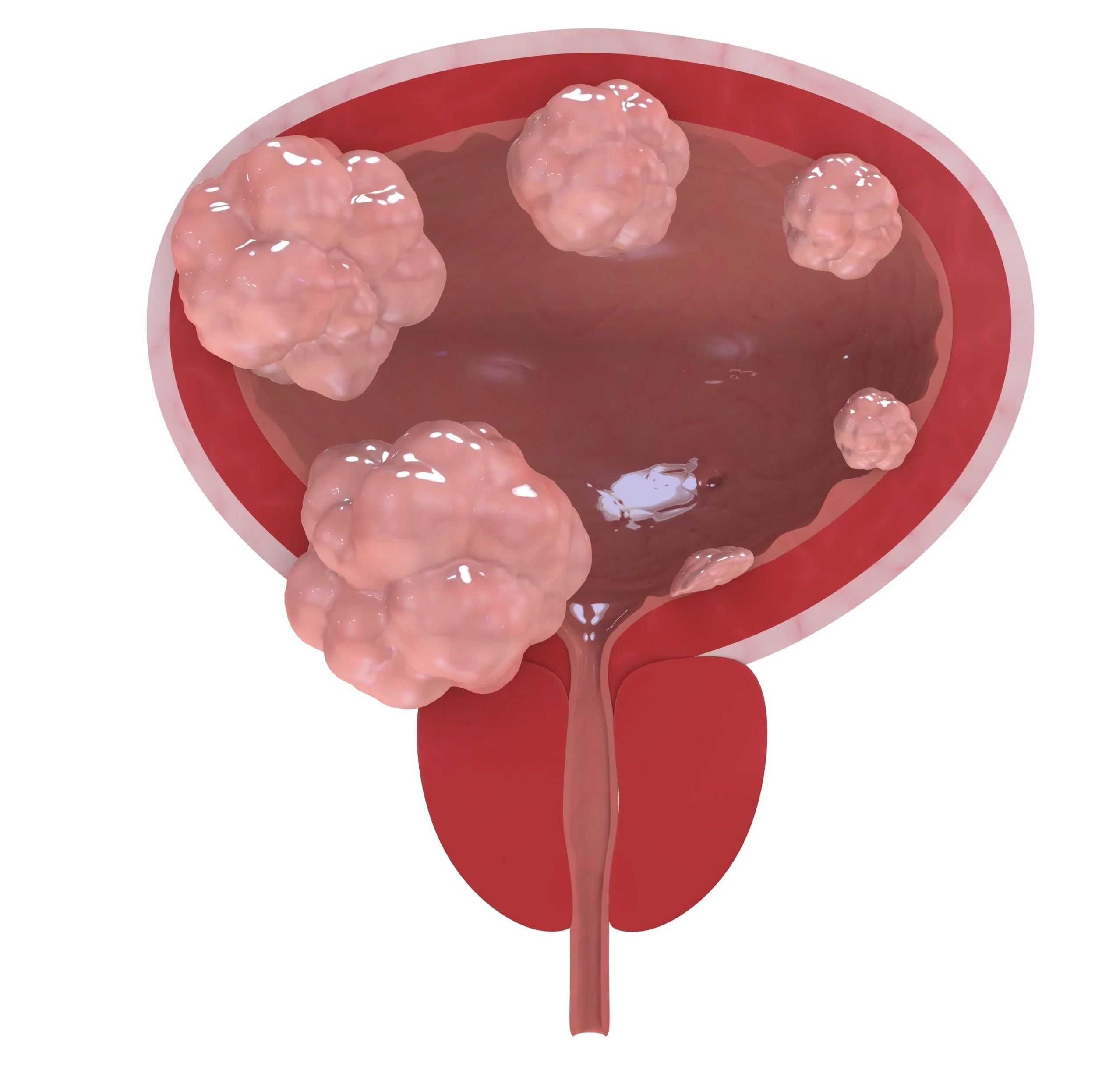 bladder-stages.jpg
