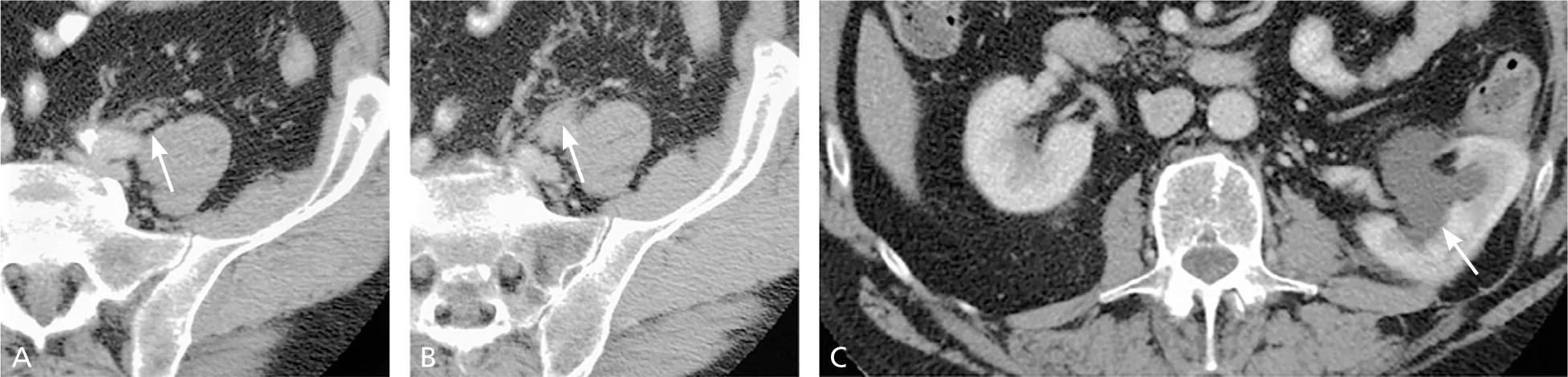 Example of how hematuria workup lead to completing a multiphasic computed tomography urography in a 53-year-old man with hematuria secondary to a transitional cell carcinoma of the left ureter shows thickened, enhancing ureteric wall (arrow) with periureteric fat stranding (arrow) suggestive of a urothelial lesion with extramural spread of the disease. (C)Proximal hydronephrosis with hydroureter (arrow) is noted.