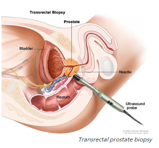 Prostate BIopsy.PNG