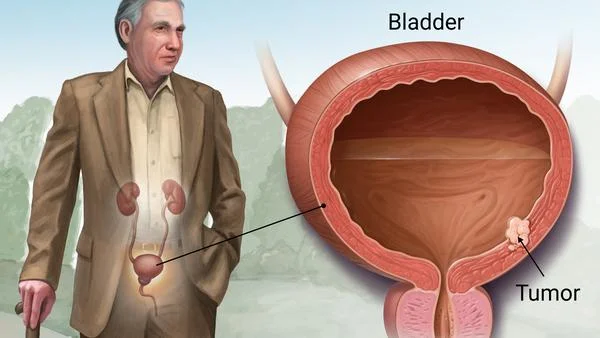 Bcg Treatment - Therapy For Bladder Cancer — Fairbanks Urology