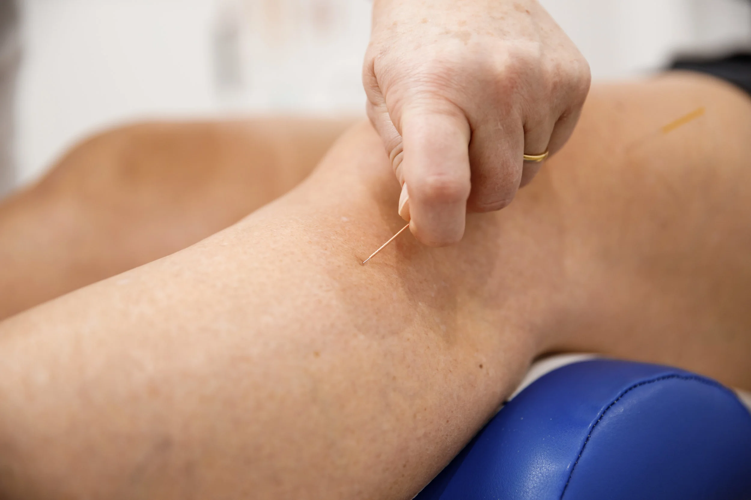 Acupuncture for knee pain