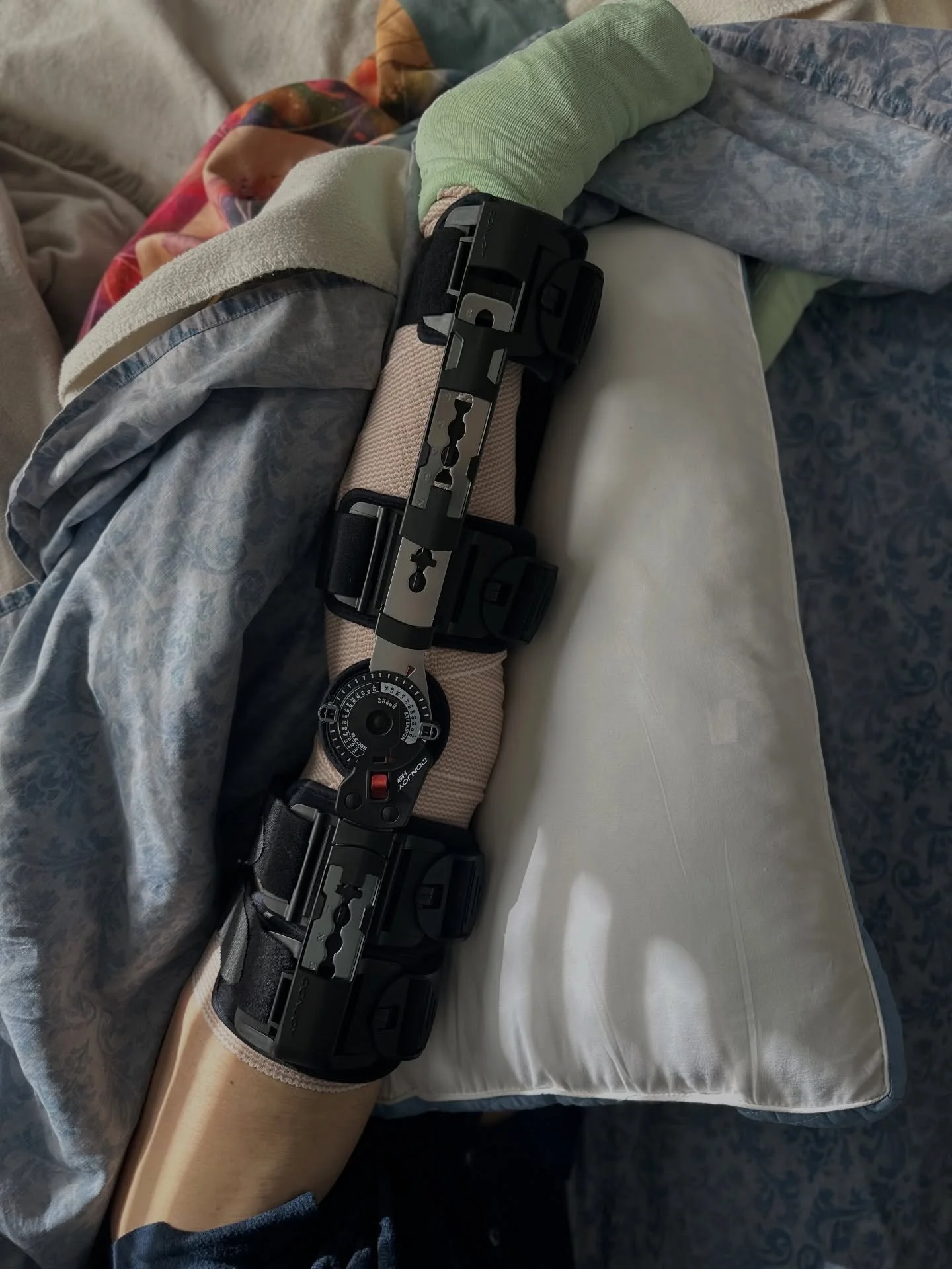 This was unexpected! Pre- and post-surgery. Soft tissue scope surgery will be down the road. Now that the brain fog is clearing I&rsquo;m thinking that maybe I REALLY shouldn&rsquo;t have procrastinated on those projects in the workshop which require