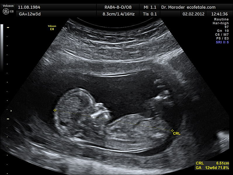 12-week-ultrasound.jpg