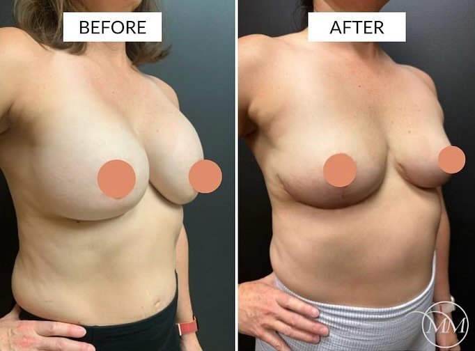 This 49 year old was seen in consultation for breast implant removal! With a prior mastopexy augmentation in 2006 by another surgeon, this beautiful patient hadn&rsquo;t been feeling well and was hoping the implants were the cause. Here she is before