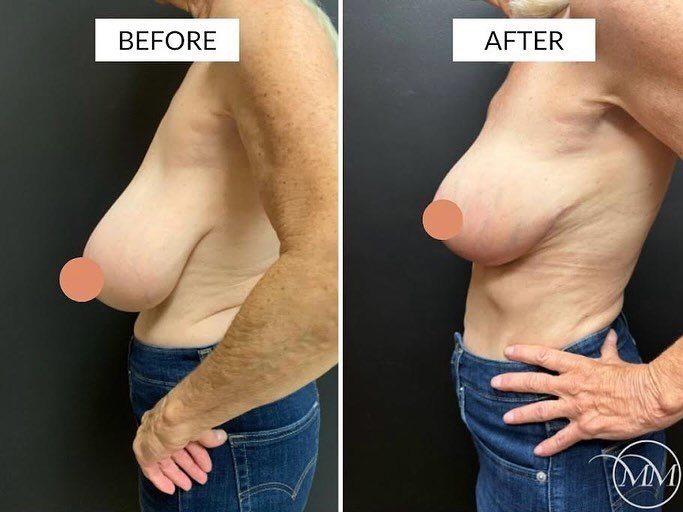 This 65 year old was seen in consultation for a breast reduction! After living the majority of her life with large and dense breasts, this beautiful patient wanted relief from her symptomatic macromastia. Here she is before and after a bilateral brea