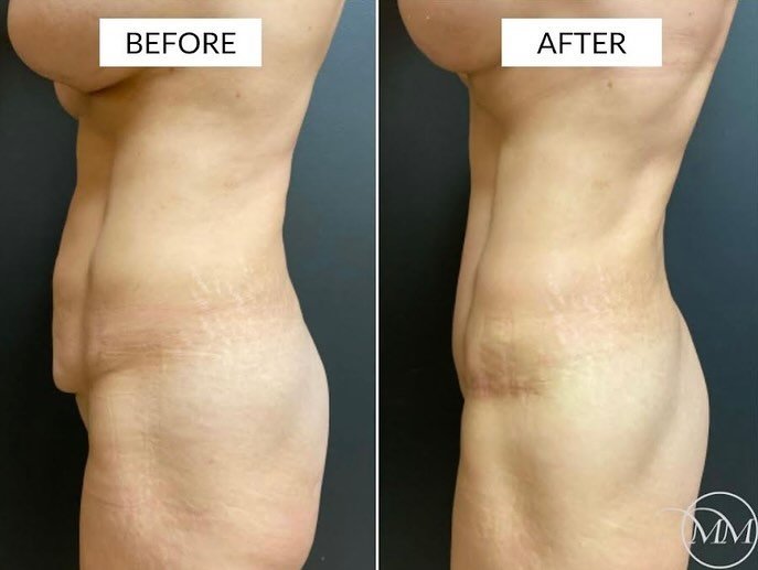 This 46 year old was seen in consultation for postpartum abdominal improvement! Extremely fit with excellent muscle tone, this beautiful patient wanted the excess skin removed from her anterior abdomen. Here she is before and after a full abdominopla