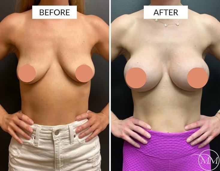 This 36 year old was seen in consultation for postpartum breast enhancement! After breastfeeding her children, this beautiful patient was ready for a fun change. She wanted to go from a B-cup to a D-cup. Here she is before and after a bilateral breas