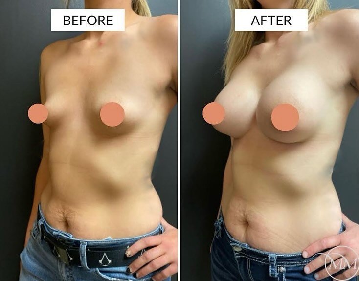 This 26 year old was seen in consultation for postpartum breast enhancement! After thinking about having a breast augmentation for some time, this beautiful patient decided she was ready! Here she is before and after a bilateral breast augmentation w