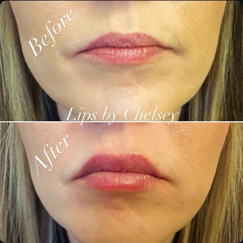 Lips by Chelsey 💉💋 .55cc Juv&eacute;derm Volbella lip filler (half syringe) 

🚨due to high demand June 26 now available for appointments🚨

To make an appointment call the office at (530) 638-8868 

Last opportunity to enjoy our buy one get one Sp