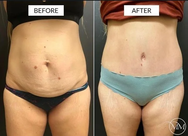 This 46 year old was seen in consultation for a tummy tuck! After living with postpartum changes to her abdomen, this beautiful patient was ready to remove the excess skin/fat and to trade out her multiple c-section scars. Here she is before and afte