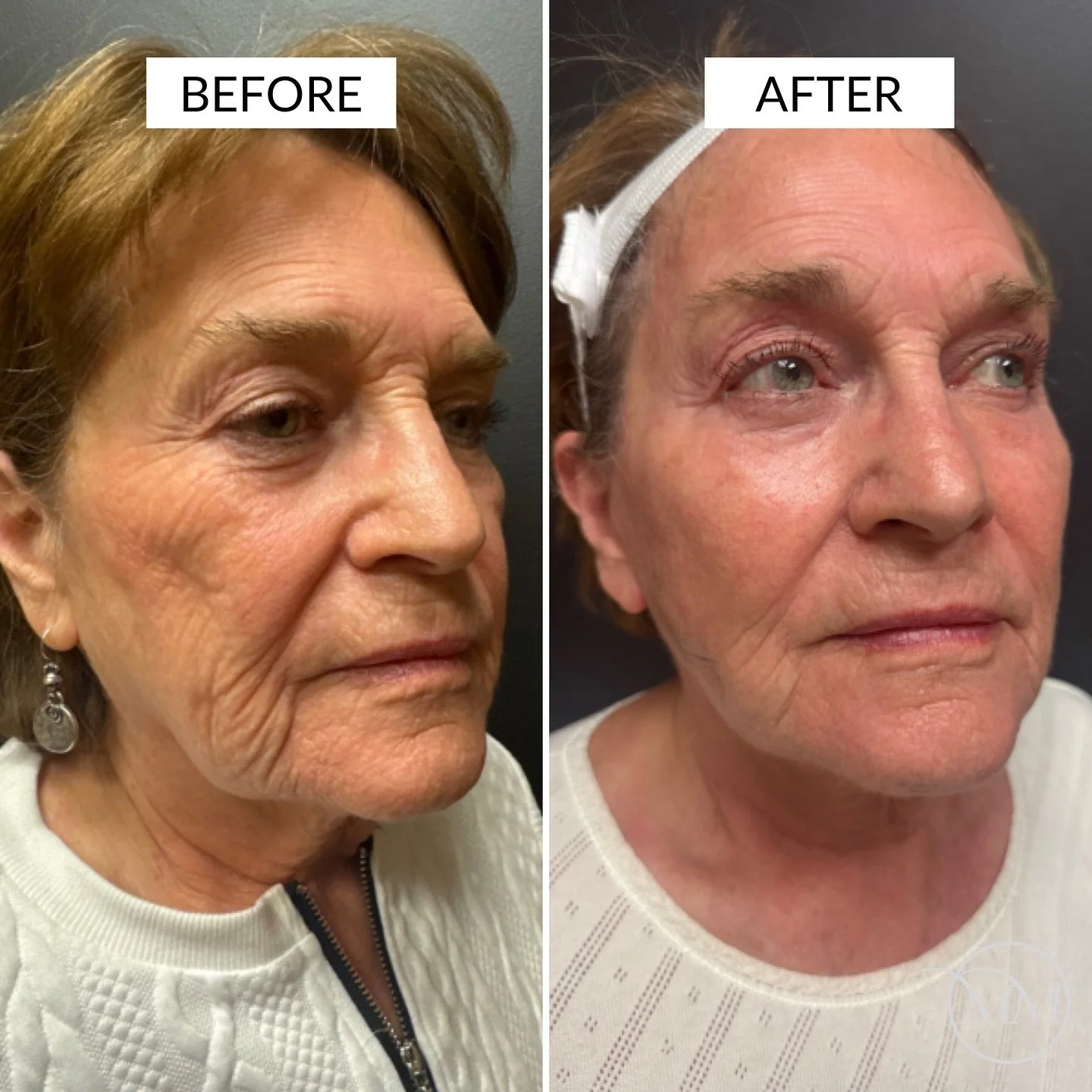 This 75 year old was seen in consultation for facial rejuvenation! After resorting to other options to help her skin as she aged, this beautiful patient had waited long enough and found the right surgeon to address the areas of her face that had been