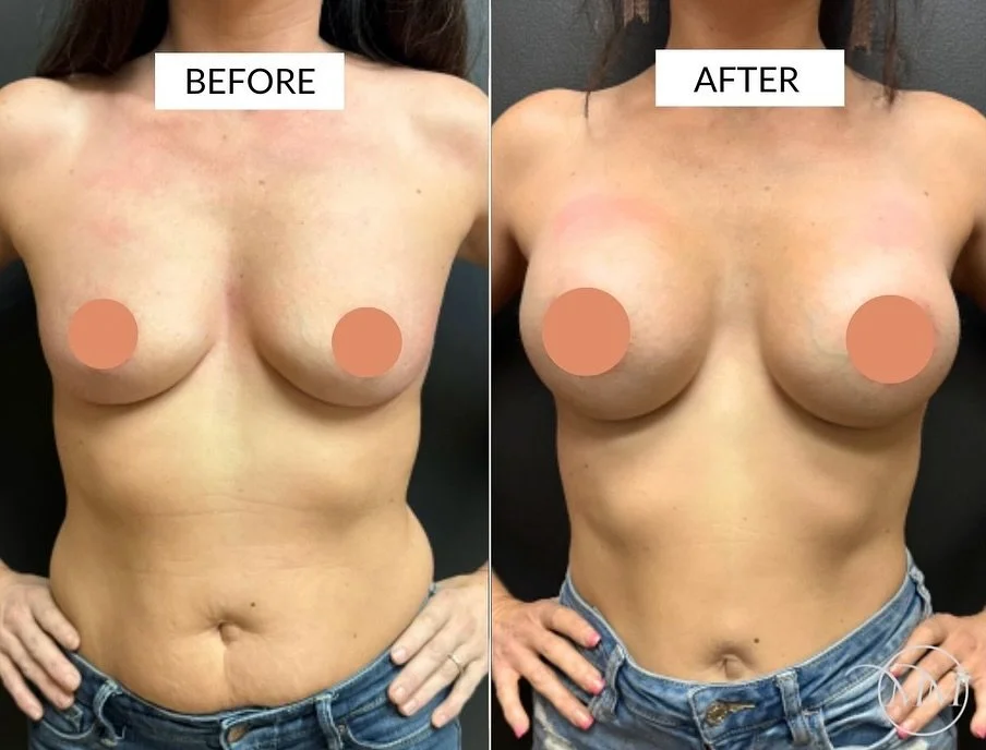 This 37 year old was seen in consultation for postpartum breast enhancement! After having multiple children and breastfeeding all, this beautiful patient wanted her upper pole fullness back along with an enhanced size. Here she is before and after a 