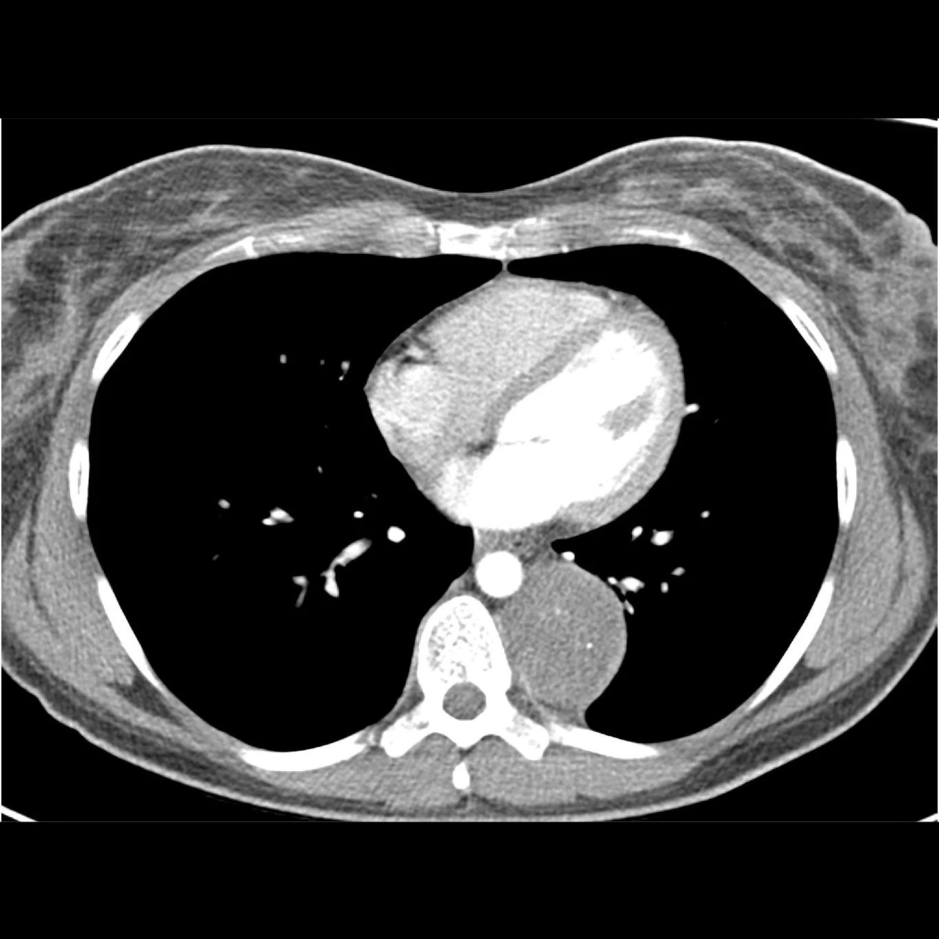Robotic Resection of Paraspinal Ganglioneuroma (32:19)