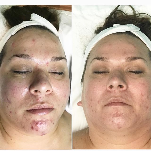 This is what only 8 weeks into my acne program looks like! We are so close to being 100% clear!!!
This client was using prescription acne medicine that wasn&rsquo;t working for her before she came to see me. Now she is using healthy skin care, living