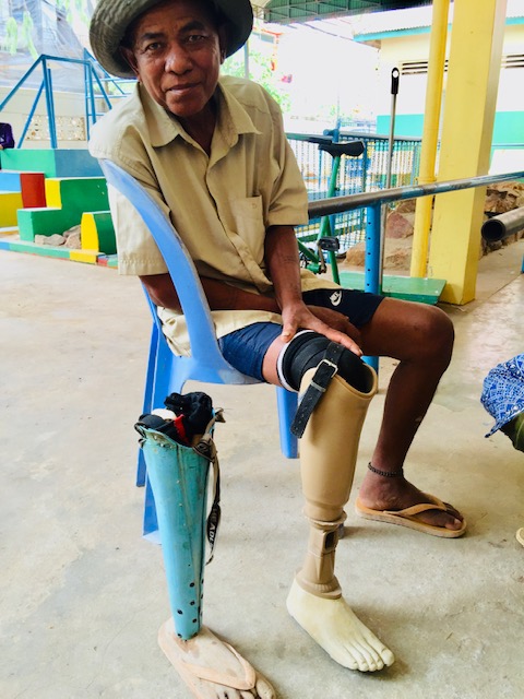 Homemade Prosthetic Leg