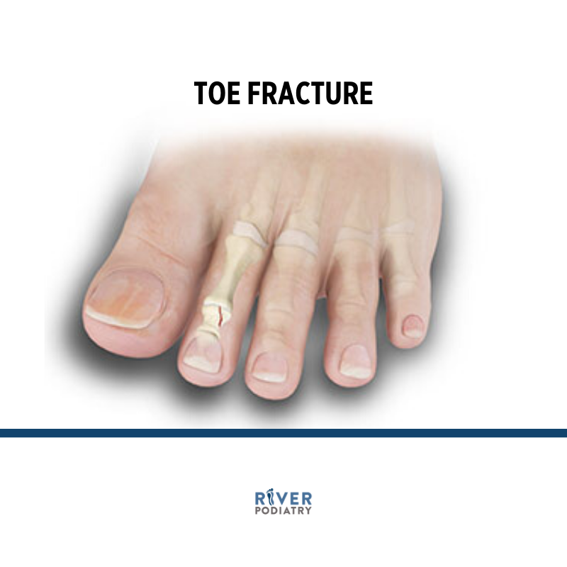 Toe Fractures — River Podiatry I The Foot and in NY/NJ